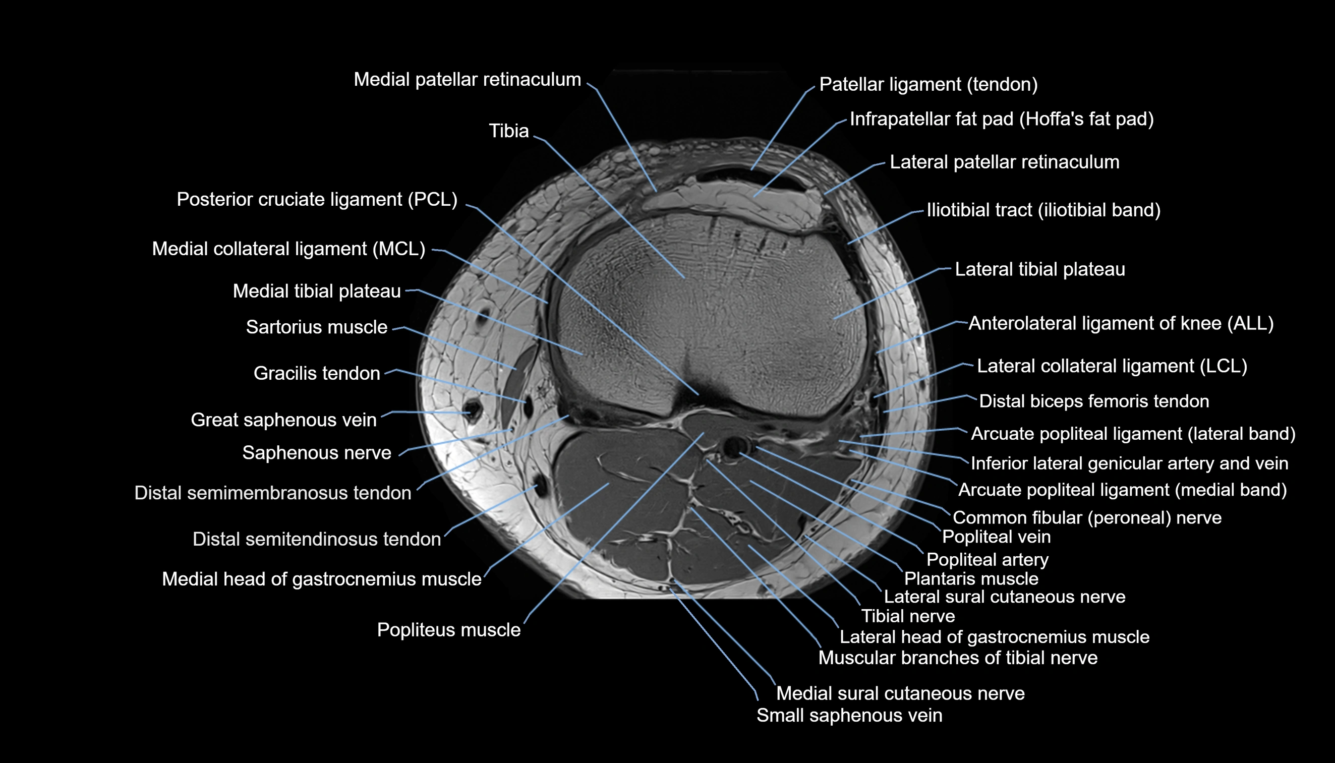 MRI knee  axial cross sectional anatomy 3T radiology  image-img-00001-00034.webp